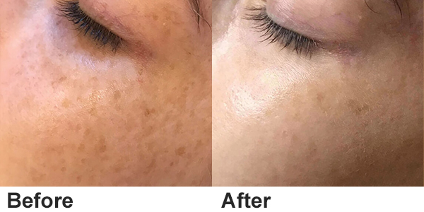 tattoo removal machine