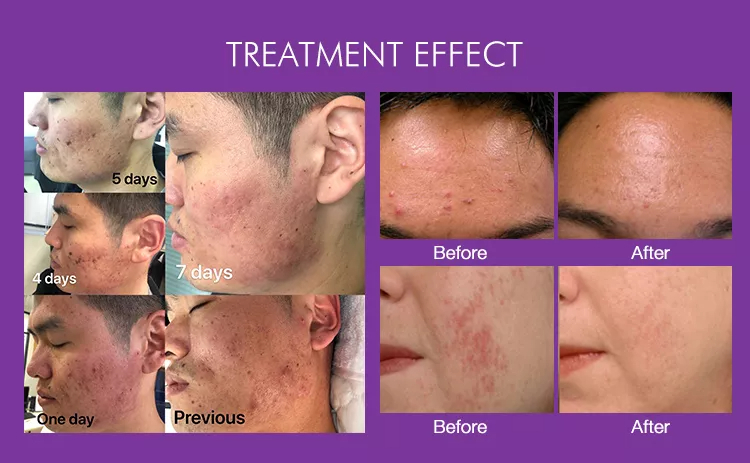 co2 laser for acne scars
