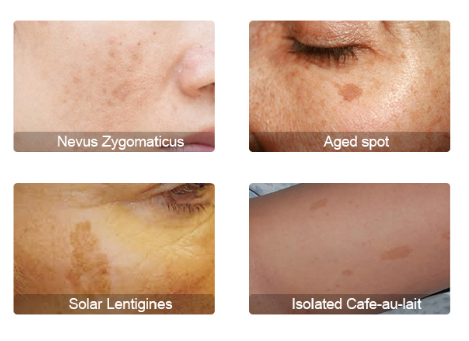 laser tattoo removal machine cost