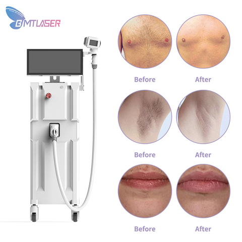 Permanent Hair Removal 808nm Diode Laser Machine Philip Lumea Device Kenzzi