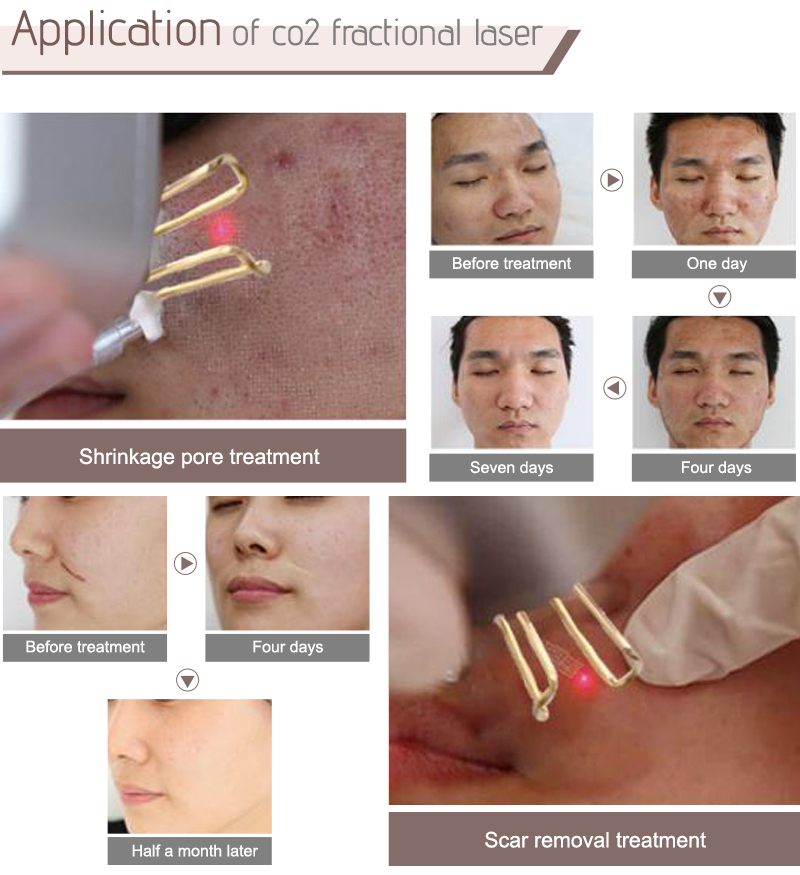 fractional laser for scars