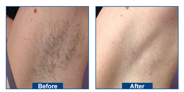 808nm diode laser hair removal machine