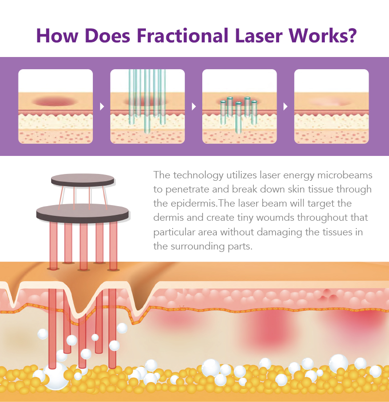 Fractional CO2 Laser Machine 60W Skin Rejuvenation Vaginal Tightening Laser Acne Scar Removal