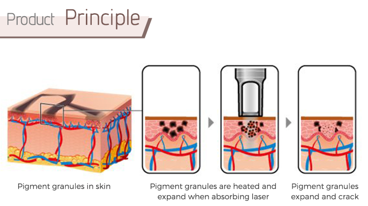 Q-Switched Nd YAG laser tattoo removal machine