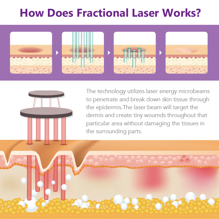 fractional CO2 laser machine