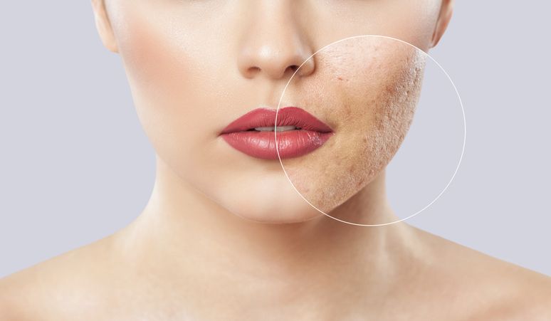 Q-Switch Laser: The Key to Effective Skin Treatments