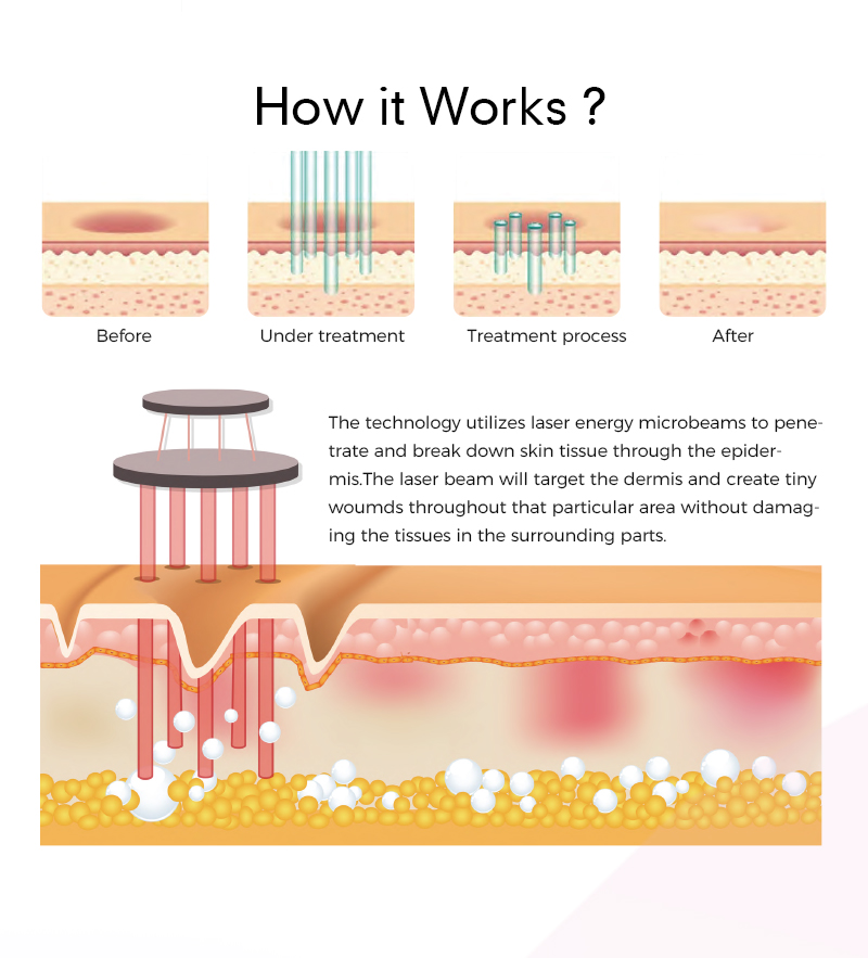 Erbium YAG CO2 Laser Machines for Skin Treatment