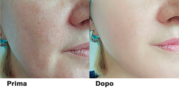 laser tattoo removal machine