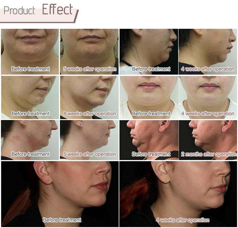 cool slimming machine