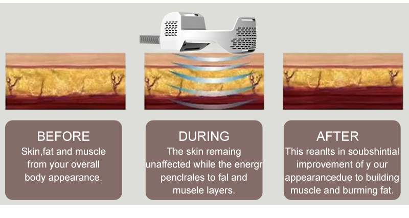 emsculpt machine cost to buy