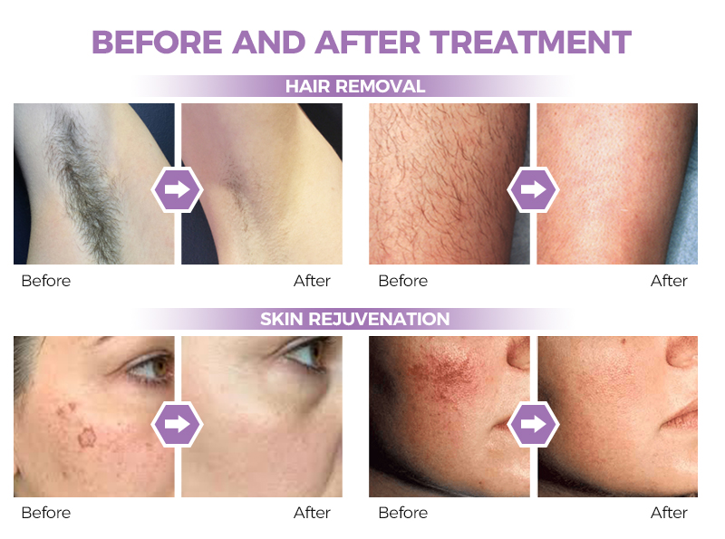 skin lifting tighting