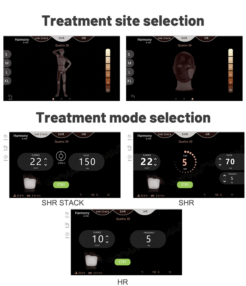 soprano laser hair removal