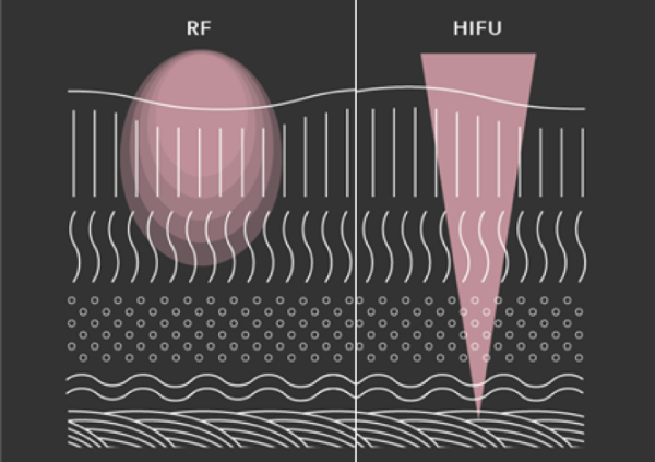 HIFU VS Fractional RF Skin Tightening