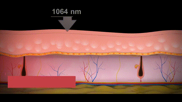 tattoo removal machine