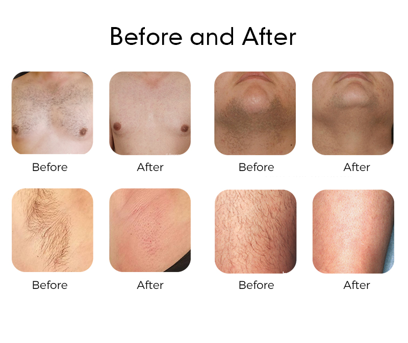 Gentle YAG Laser Pro before and after treatment