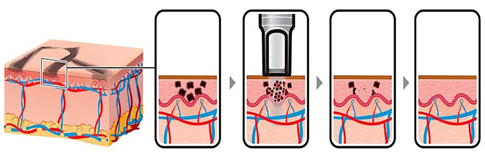 pico laser tattoo removal