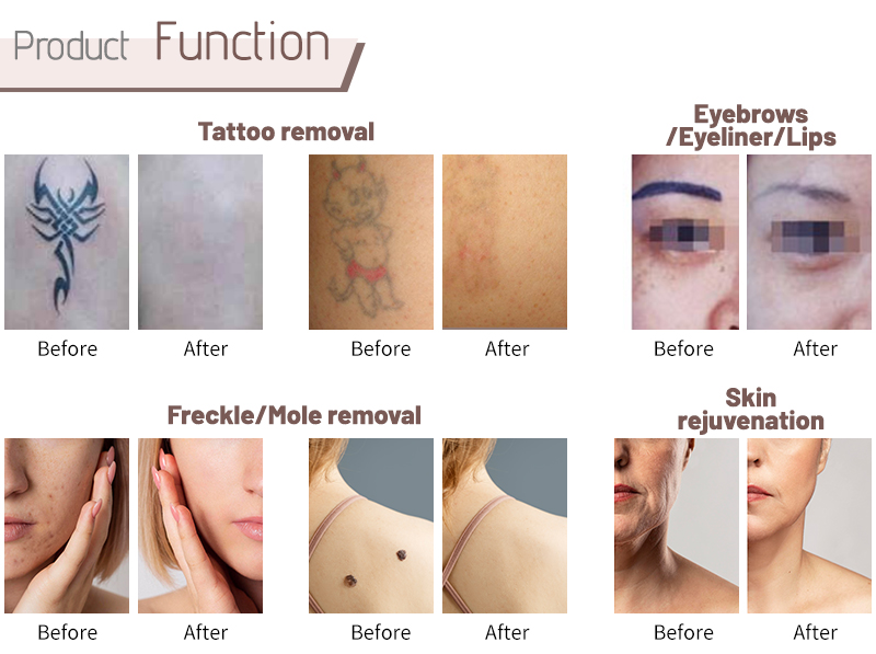 q switched nd yag laser before and after