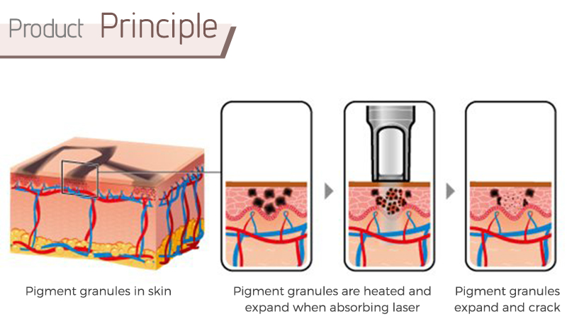 q switch nd yag laser