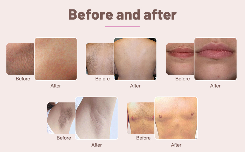 laser diode hair removal