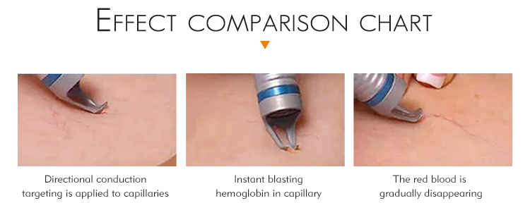 hyperpigmentation removal