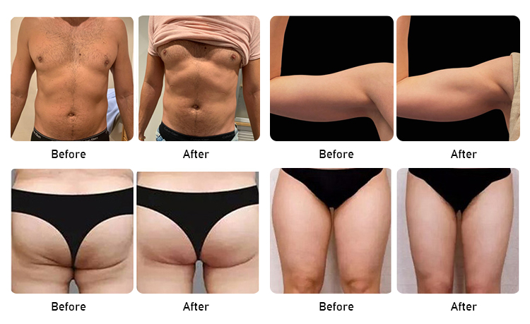 cost of emsculpt machine