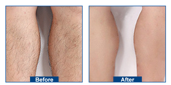 808nm diode laser machine