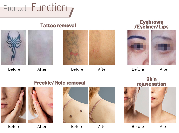 Advanced laser tattoo removal equipment