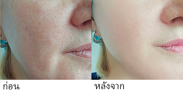 laser tattoo removal machine