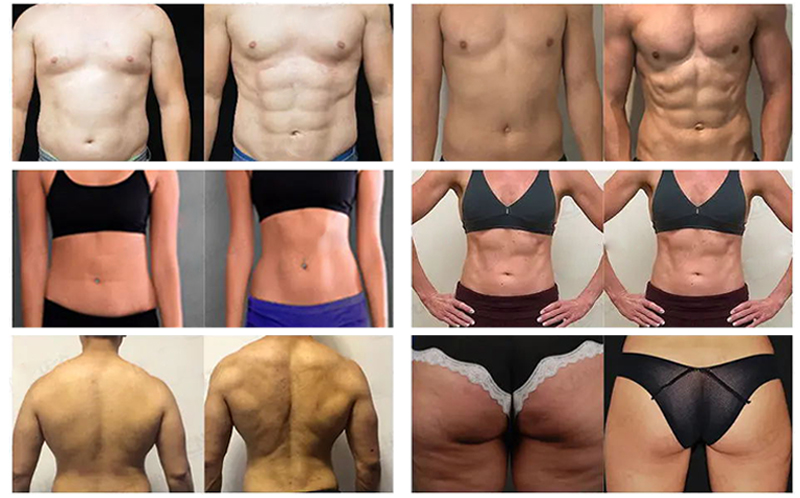 emsculpt machine professional