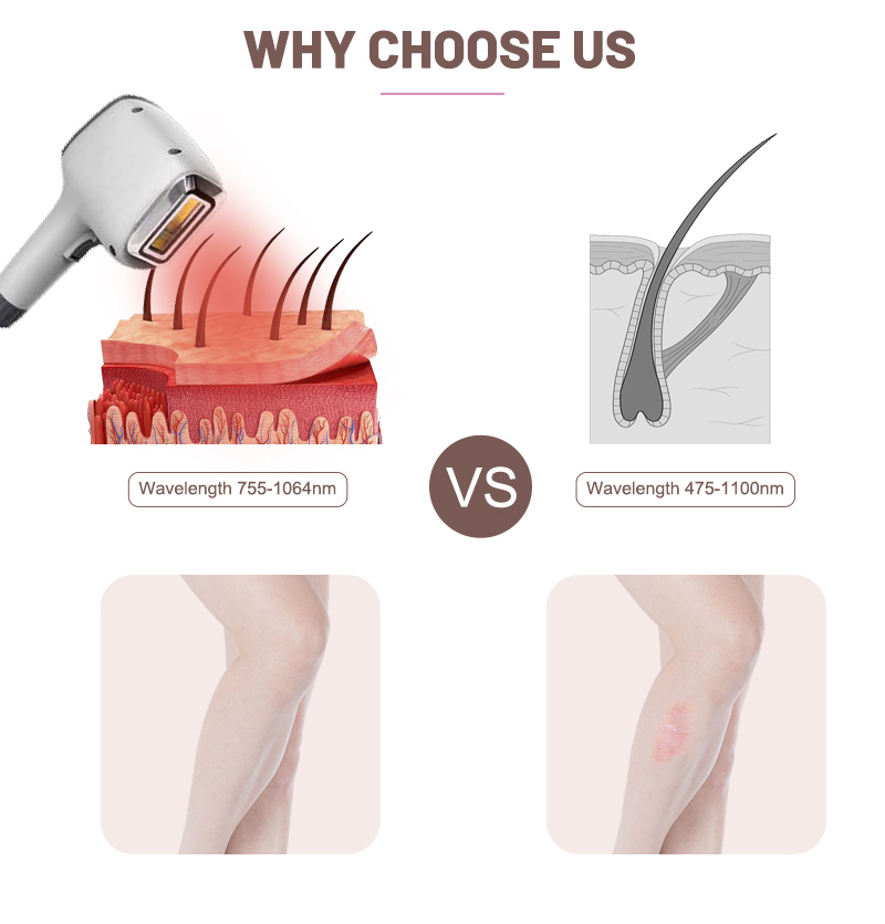 kenzzi hair removal