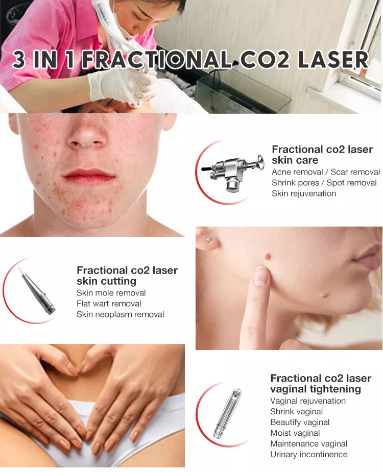 co2 laser skin resurfacing