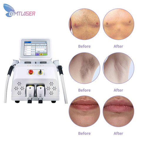 Professional Ipl Machine Laser Removal Face Rejuvenation