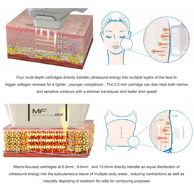 professional hifu machine