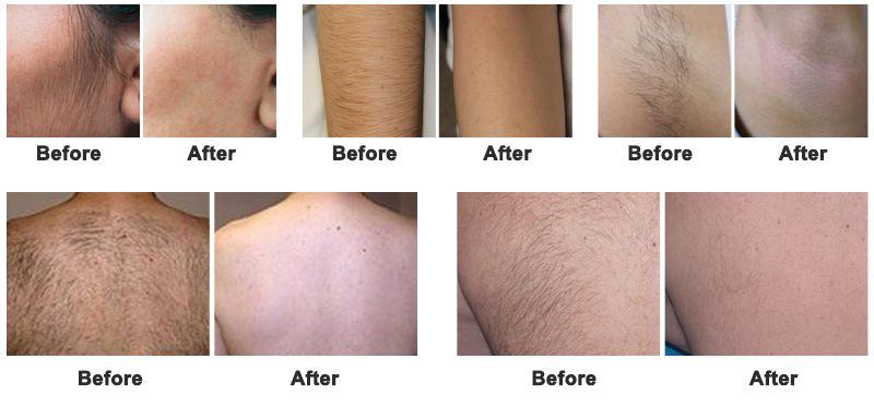 laser hair removal machine price