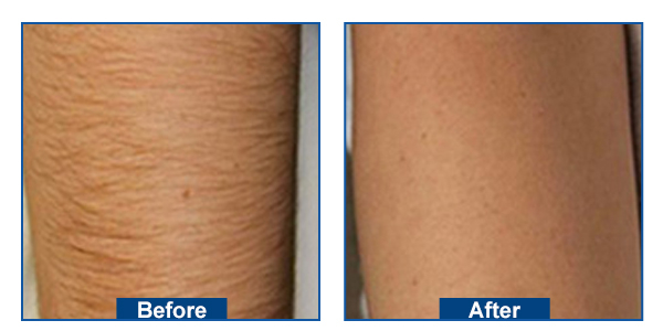 Laser Hair Removal