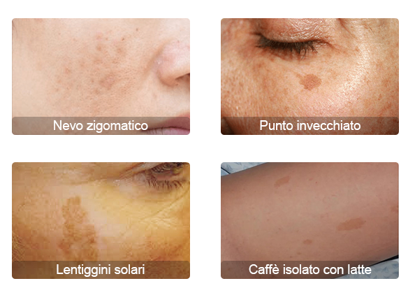 laser tattoo removal machine cost