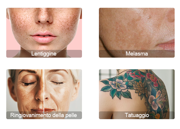 laser tattoo removal device
