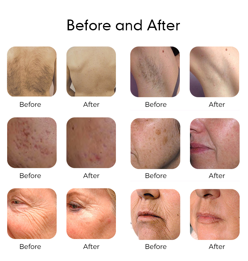 1927nm Thulium Fractional Laser for Anti-Aging RF Therapy And Face Lift Machine