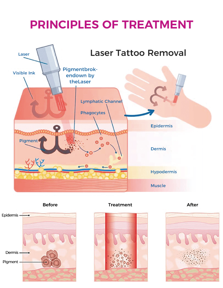 Nd:YAG Q-switched Laser Machine for Tattoo And Hair Removal