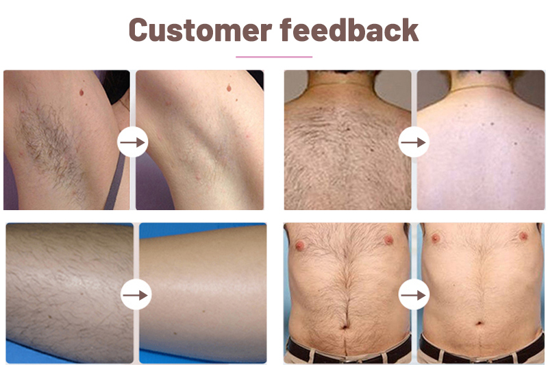 best hair removal for women