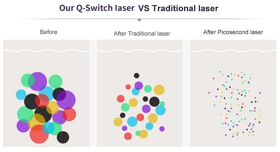 tattoo removal machine