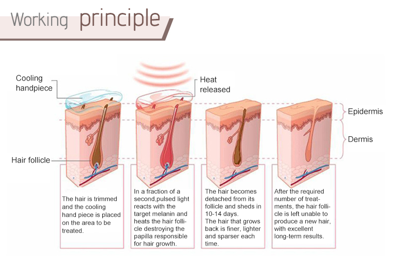 diode laser hair removal machine