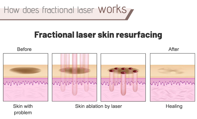 co2 fractional laser resurfacing