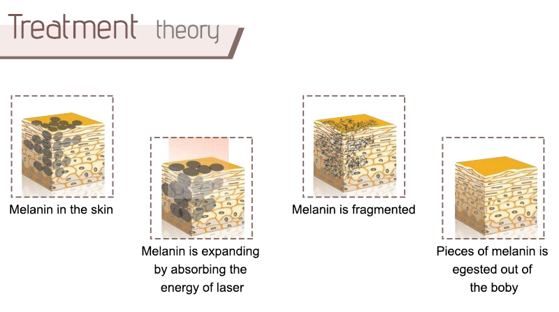 pico laser tattoo removal