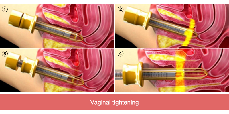 vaginal tightening