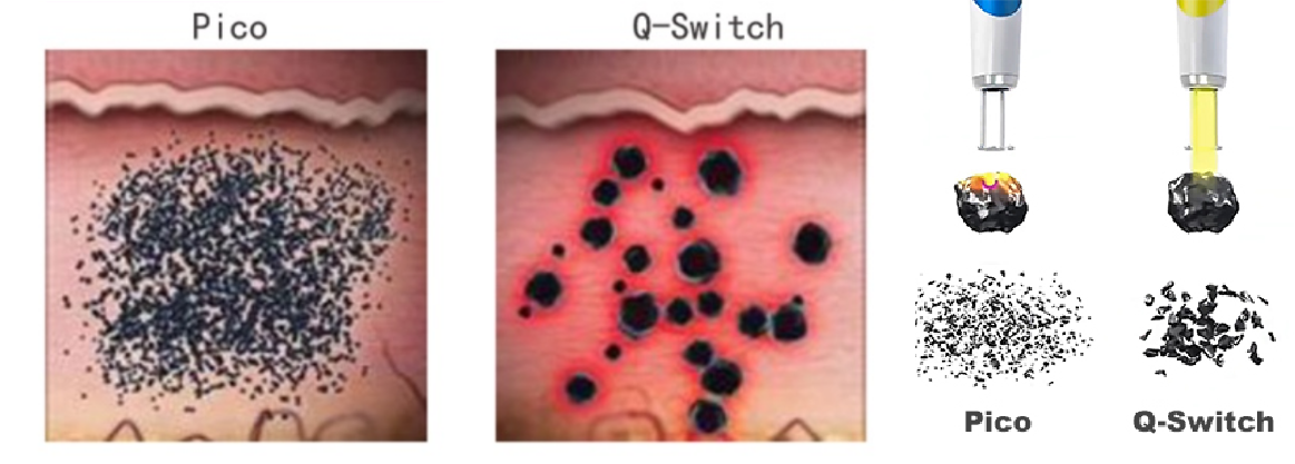 tattoo removal machine