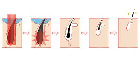 laser hair removal