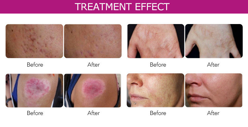 Vacuum Rf Microneedling