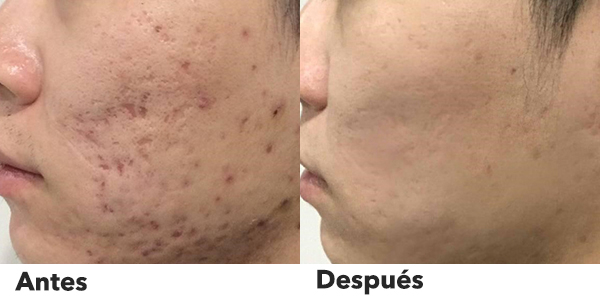 tattoo removal laser