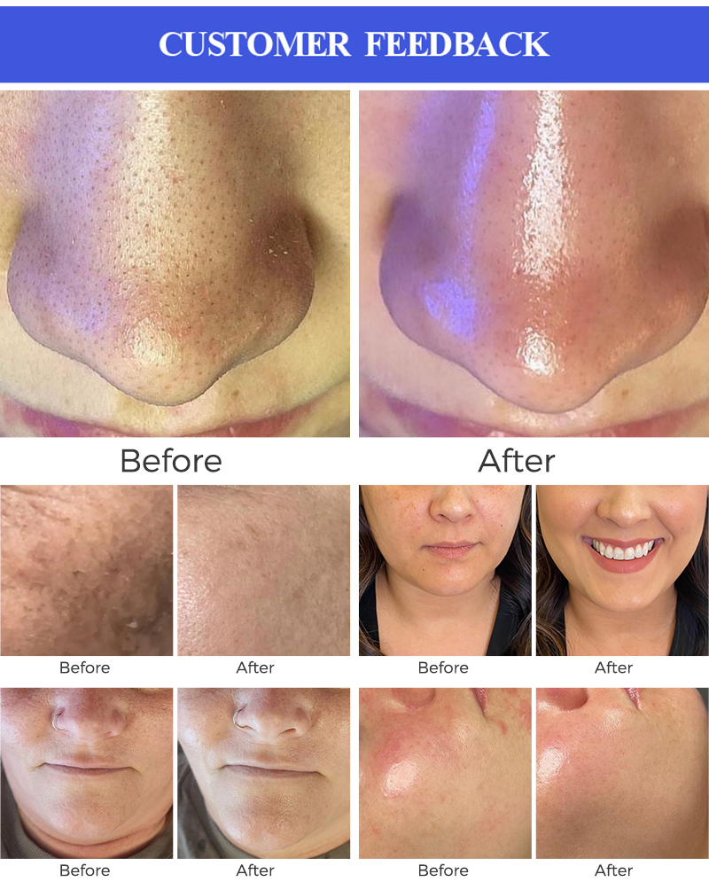 hydrafacial skin care